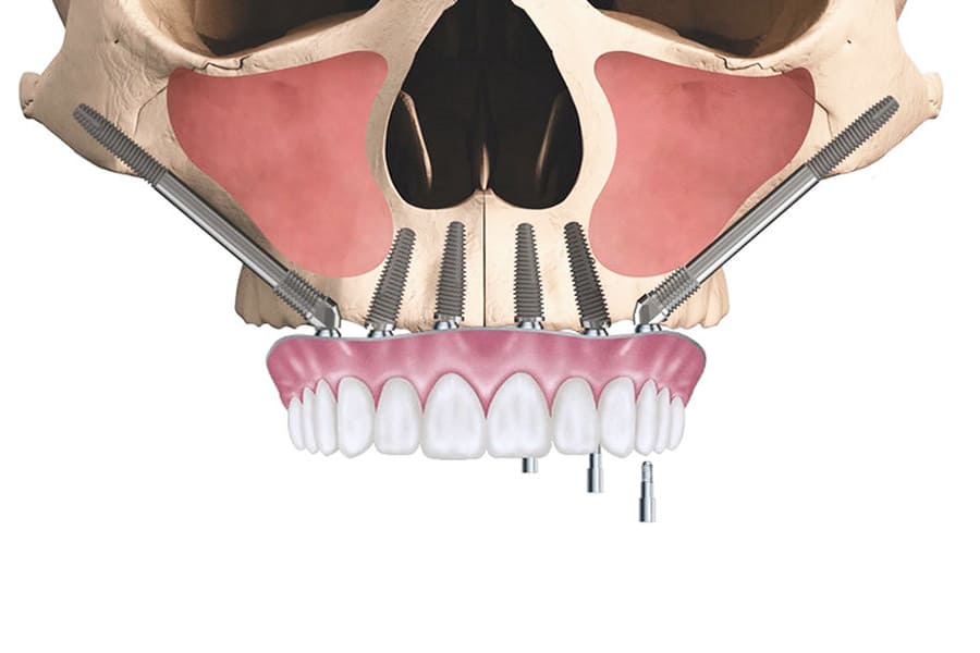 Скуловая имплантация как альтернатива синус-лифтингу при выраженной атрофии верхней челюсти