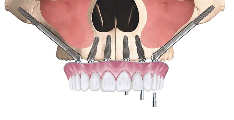 Скуловая имплантация как альтернатива синус-лифтингу при выраженной атрофии верхней челюсти